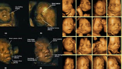 4 Boyutlu Ultrason ( 4D USG )